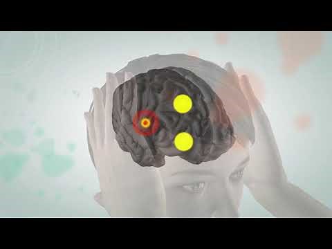 Animated video illustrating the pathophysiology of migraine