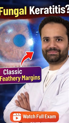 Dr Kashif Aziz | Eye Care Specialist on Instagram: "Classic Feathery Margins on Slit Lamp – Fungal Keratitis 🔬 High-magnification slit lamp examination demonstrating a stromal infiltrate with feathery edges, highly suggestive of fungal keratitis. Key clinical features observed: ▪️ Dry, elevated stromal infiltrate ▪️ Irregular feathery borders ▪️ Possible satellite lesions ▪️ Endothelial plaque (when present) Clinical suspicion should be high in cases with: 🌾 History of vegetative trauma 💊 Pri