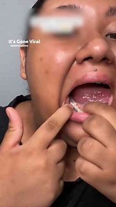 Never get a piercing with braces