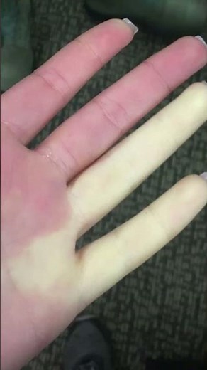 Raynaud's disease overview
