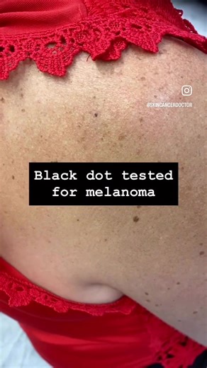 Understanding Melanoma and Skin Checks