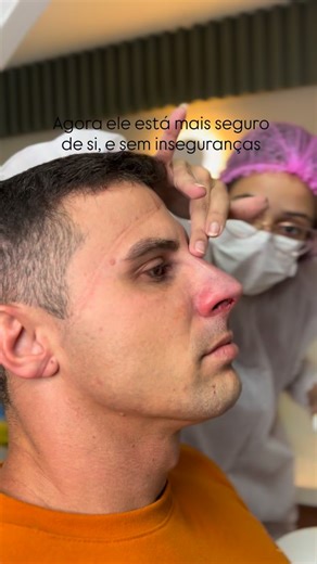 A pedido da esposa ele realizou a rinomodelação. Deixou pra trás o medo, e ganho mais autoconfiança, autoestima, e ficou mais seguro de si. Não terá mais vergonha de tirar fotos | Silva Martins Odontologia
