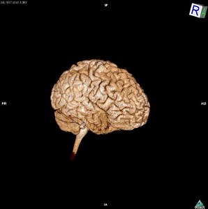 Osirix 3D volume rendering of Brain
