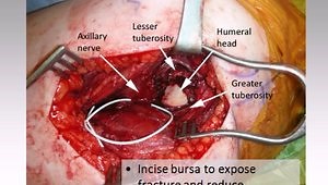 Proximal Humerus ORIF: Exposure and Reduction Techniques
