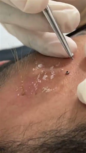 Piercing freaks #bodypiercing #piercing #piercingfail #piercings #satisfying