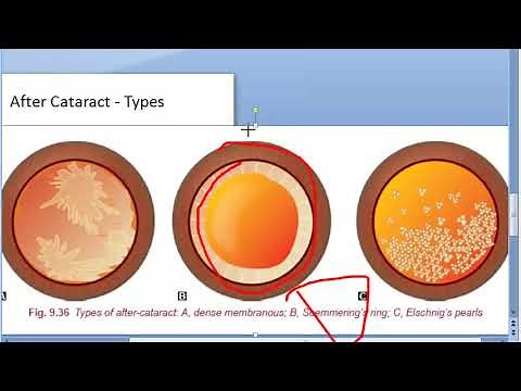 Ophthalmology 223 After Cataract Secondary Soemmerring ring Elschnig pearls Nd YAG Laser Treatment