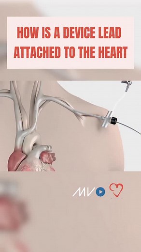 21K views · 718 reactions | How are device leads attached to the...