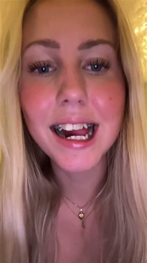 My teeth after 2 year of braces 🦷 #braces #transformation #orthodontist