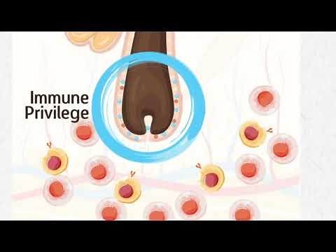 Pathophysiology of Alopecia Areata