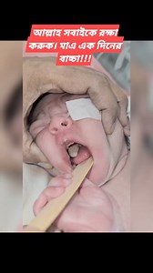 fibroepithelial polyp #ডা_তারেক_মোহাম্মদ #reelsbd #reelsfb #নাকেরপলিপাস #csf_rhinorrhoea #নাক_কান_গলা_বিশেষজ্ঞ #বধিরতা #নাকের_পলিপাস #নাক_কান_গলা #টিউমার | Dr. Tareq mohammad. ENT and head neck surgeon