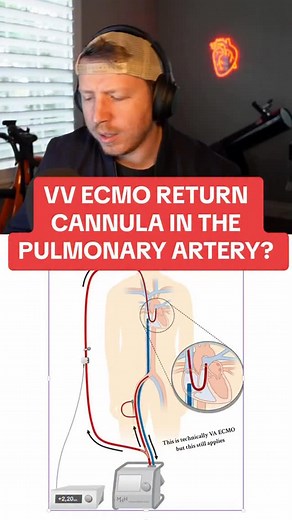 6.7K views · 79 reactions | ECMO return cannula in the Pulmonary Artery?? Why?? . Check out the ICU STARTER BUNDLE and the other Nurse Dose Cheat Sheets/Resources in the bio! . Follow for more ICU nursing education!  . #cvicu #cardiacnurse #criticalcare #nursingschool #icunurse | Nurse Dose Podcast | Facebook