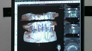 Do You Have Missing Teeth or Dentures? Learn About the Prettau Bridge and CT Scan Technology