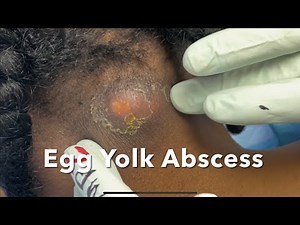 Giant neck Abscess. Egg Yolk Abscess. Incision and Drainage. Large Cyst Pop.