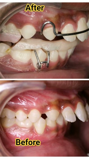 Correction of deficient mandible with twin. block appliance. Stay tuned for results🧐#shorts