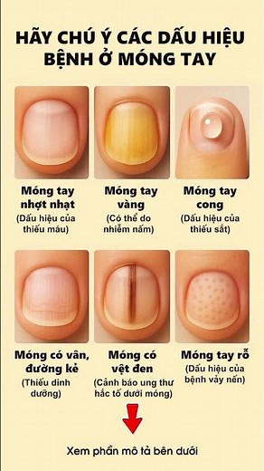 Móng Tay Nói Gì Về Sức Khỏe Của Bạn?