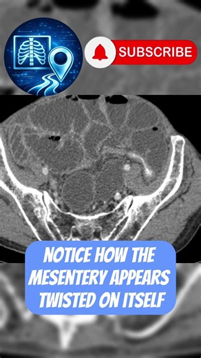 Something Is Twisting… Would You See It? #radiology