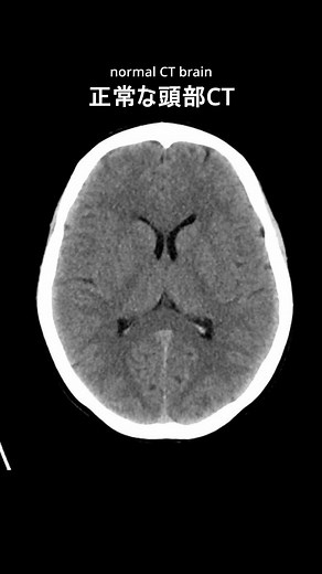 Understanding Brain Scans: CT Imaging Explained