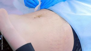 Doctor wiping cotton pads patient abdomen after carboxytherapy, closeup view. Beautician disinfects after injection of carbon dioxide. Treatment, cure of skin tags and stretches on tummy, belly.