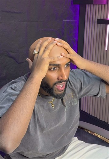 I made a huge mistake… #foryou #fyp #bald #hairtransformation #toronto | Hair Transformation