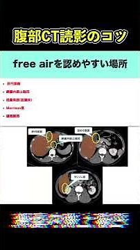 free airを認めやすい部位(その1)【腹部画像診断のコツ】#shorts