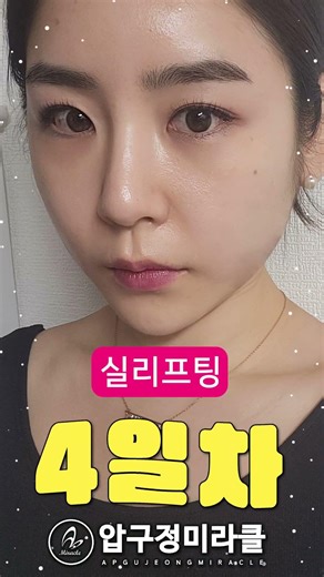 다이어트로도 해결 안 되던 턱선, 실리프팅으로 처진 부위만 다시 잡아준 결과