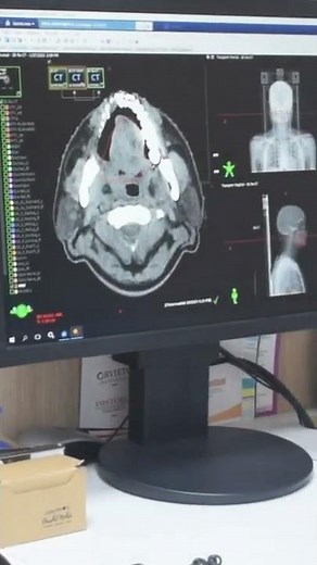 A quick overview of Radiation Therapy