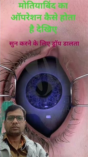 मोतियाबिंद का ऑपरेशन कैसे होता है देखिए #eyes cataract surgery procedure# subscribe my YouTube