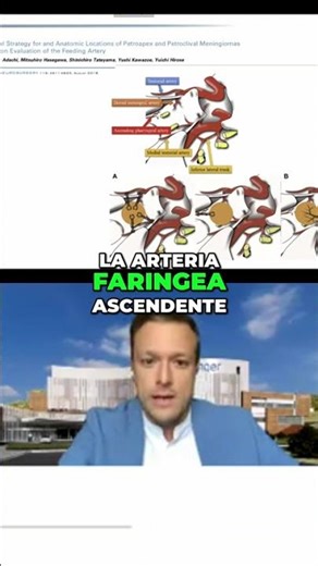 Meningiomas Petroclivales: Estrategia Quirúrgica y Vascularización #shorts