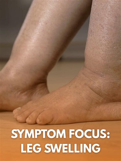 Leg swelling, also known as lower-extremity edema, is a common symptom that can develop gradually or appear suddenly. While occasional swelling after long flights or standing for extended periods can be normal, persistent leg swelling may indicate an underlying vascular condition such as chronic venous insufficiency or advanced varicose veins. Interested in more? Visit: https://www.usaveinclinics.com/vein-disease-symptoms/leg-swelling/ | USA Vein Clinics