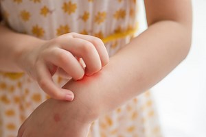 How to identify your child's rash and when to know if it's serious