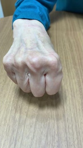 陳旧性伸筋腱脱臼