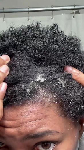 This the worst I’ve seen it in a while. #sebboricdermatitis #dandruff #scratching #flakes #