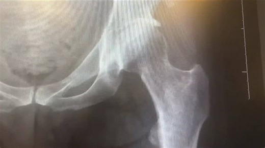 Hip dysplasia and developmental delay