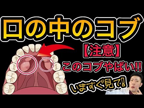 【注意】口の中のコブ注意してください！手術も必要かも!?歯茎のコブ・骨隆起