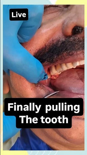 Demonstrating LIVE painless Extraction of upper Wisdom tooth By Doctor Praveen Bhatia #wisdomtooth