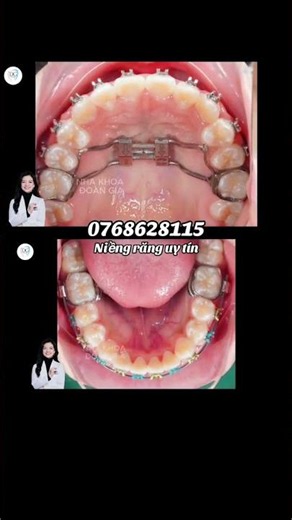 The Upper and Lower Teeth Braces Process | Doan Gia Dental