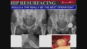 Optimal Prosthesis Design for Hip Replacement - Evidence Based