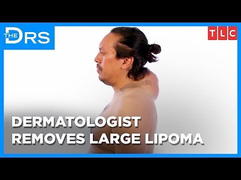 Watch Dermatologist's Largest Lipoma Removal!