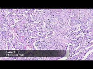 Organizing Pneumonia