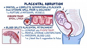 Video: Placental abruption: Clinical sciences - Video Explanation! | Osmosis | Osmosis