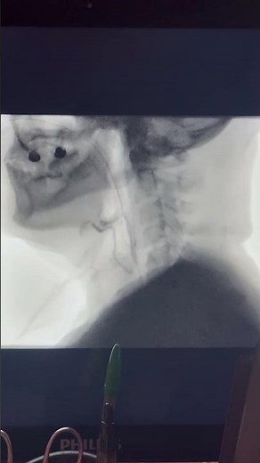 Modified Barium Swallow Screen
