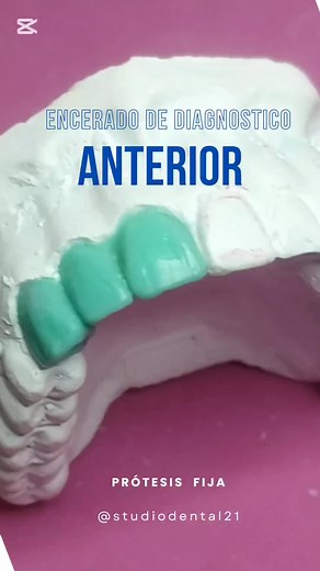 Técnica de Encerado Dental para Dientes Anteriores