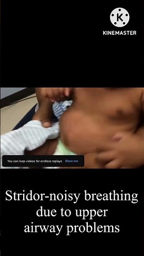 Noisy breathing due to airway problems! Stridor in baby