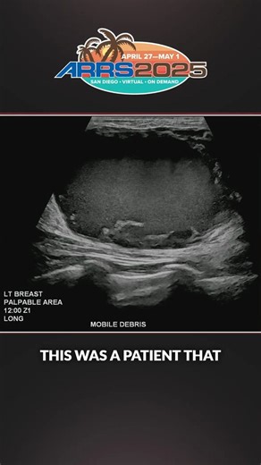 Alyssa Cubbison, DO, explains how a subtle nodularity and effective use of Doppler revealed invasive ductal carcinoma. Catch the full session, Radiology Case Review: Breast Imaging, available on demand in the ARRS 2025 Meeting Portal. https://www2.arrs.org/am25 | ARRS