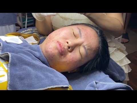 Satisfying Pimple Treatment | Loan Nguyen Acne Treatment Official