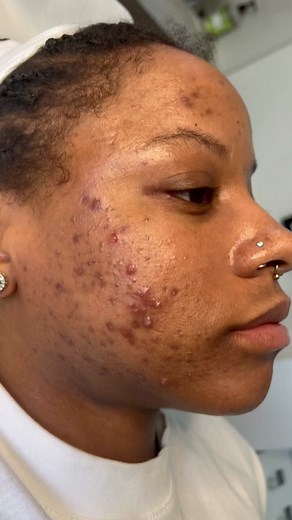 Transformación de piel impresionante en Nueva York