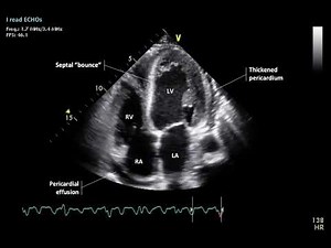 Constrictive Pericarditis Constriction Ventricular Interdependence Physiology - AP4 2D
