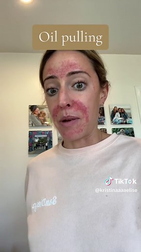 #oilpulling #oilpullingbenefits #oilpullingforteeth #coconutoil #coconutoilpulling #coconutoilforeverything #coconutoilskin #oralhygiene #oralhygienetips #naturopathicmedicine #functionalmedicine #holisticdentistry #holisticdentist #teethwhitening #teethwhiteninghack #naturalteethwhitening #naturaloralcare #naturaloralhygiene #dentist #guminflammation #dentalhygiene #oralhygienetips #gutmicrobiome #gitract #gingivitischeck #naturalremedies #naturalremedy #holistichealthtiktok #foodismedicine