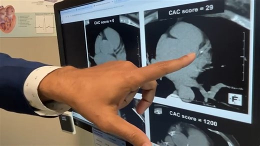 Computerized scan of heart can help prevent potential problems