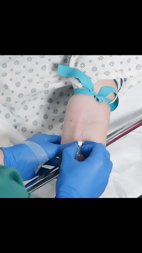 Brian “The IV Guy” on Instagram: "This is a simple one, but still a question I get a LOT. Why can’t I thread the catheter after I see flash? . One of the most common mistakes I see is when someone gets flash, they immediately try to thread the catheter. This is going to cause problems because the moment you see flash, the catheter is not yet in the lumen of the vein, it’s still in the wall. . You’re seeing flash because the BEVEL is inside the vein, but if you look closely at your IV needle you’